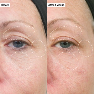 Before and after showing firmer and lifted skin on the eye