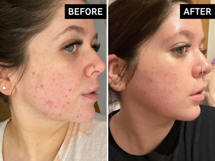 Before and after comparison of a person's face with acne on the left and clearer skin on the right.