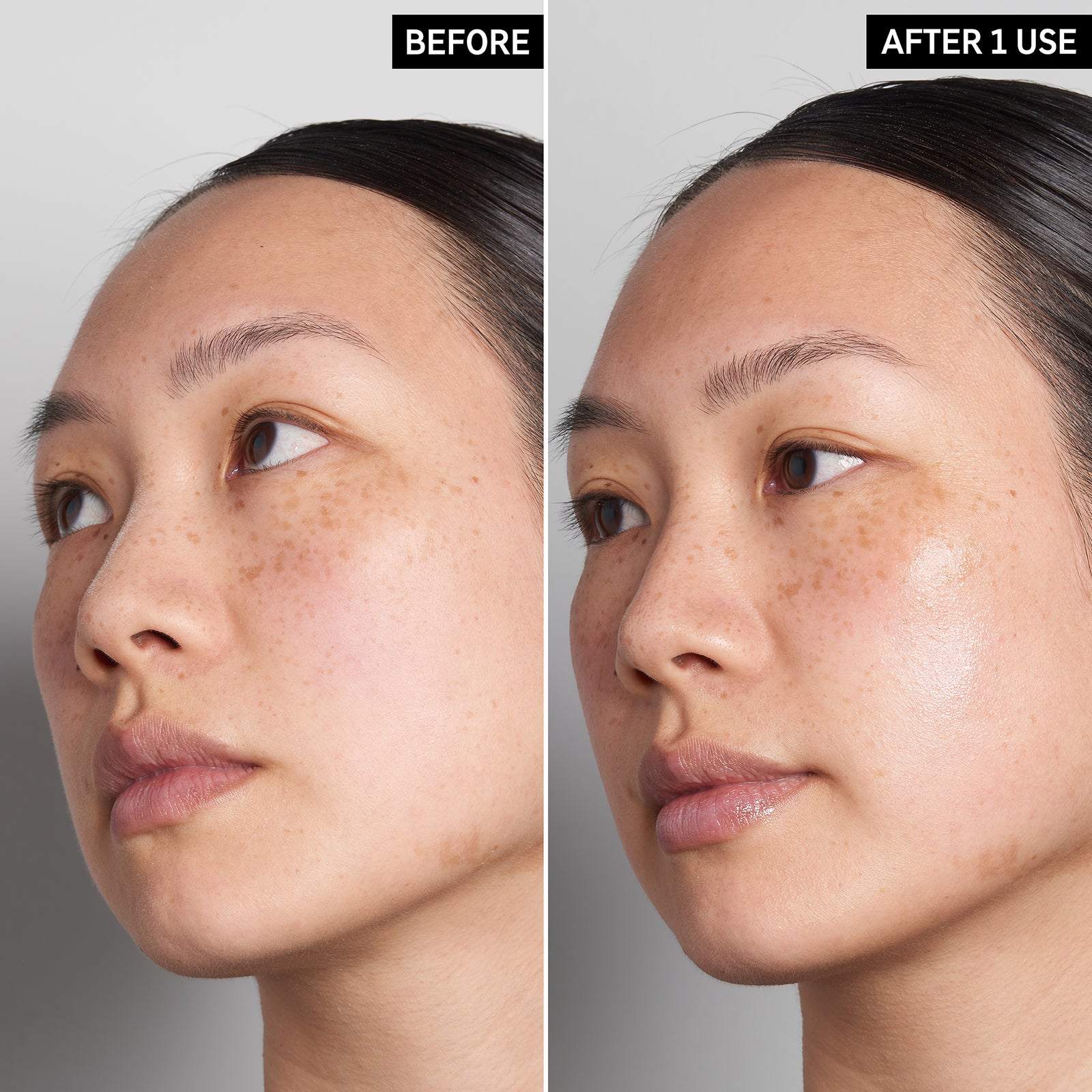 B&A using Hyaluronic Acid Serum