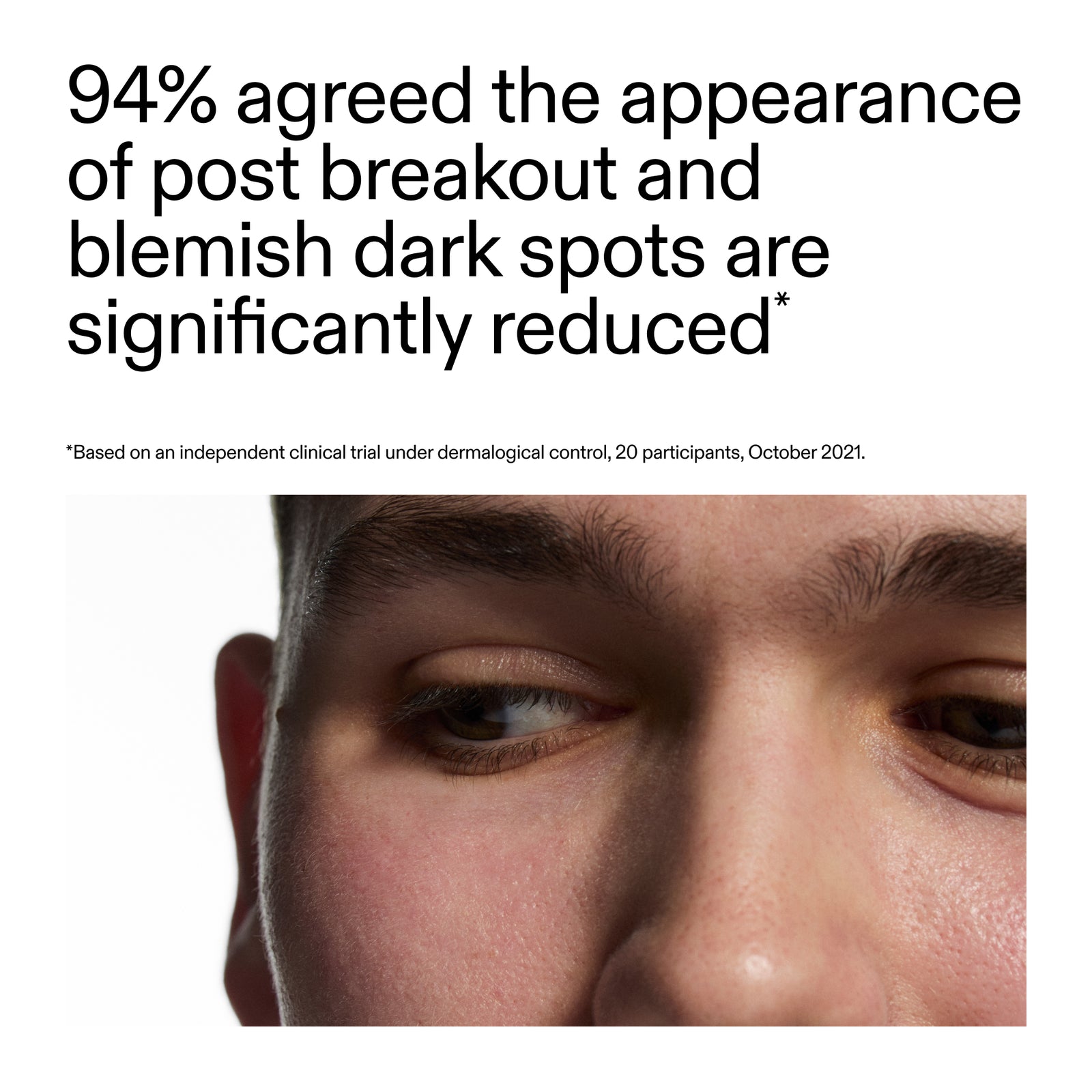 Key claim from recent clinical study of using Mandelic Acid Treatment