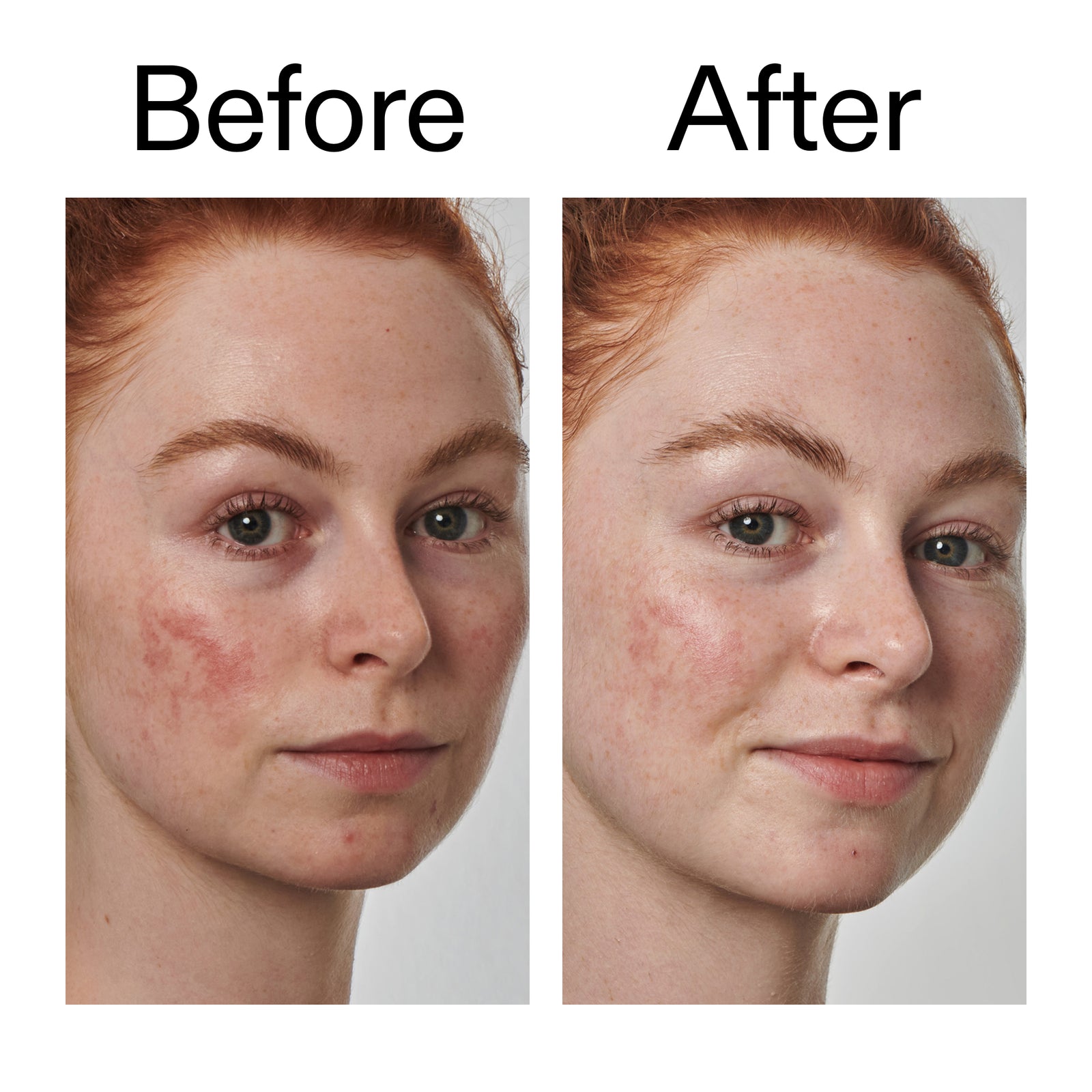 Before and after comparison of a person's face with visible skin improvement.