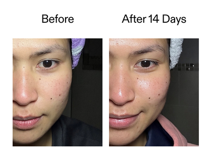 Before and after 14 days using Exosome serum
