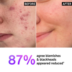 Before and after displaying results with text '87% agree blemishes & blackheads appeared reduced*'