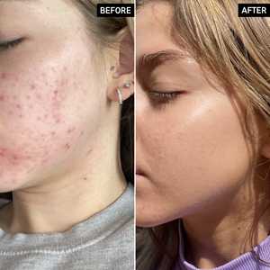 Before and After of customer using Beta Hydroxy Acid in the Deep Cleanse Duo