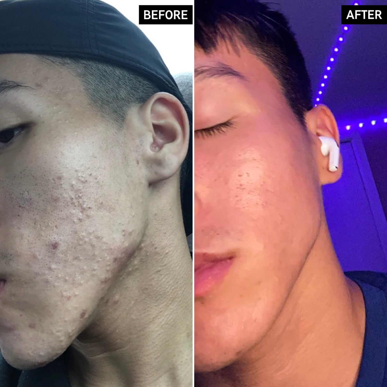 Before and after of Keanu from using the products in the Clearer Skin Cleanse Duo displaying positive results after a 3 month period