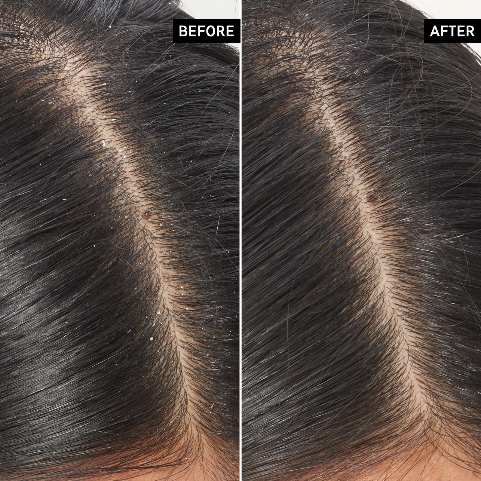 Before and after of using Salicylic Acid Scalp Treatment