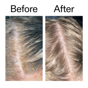 Before and after comparison of using Salicylic Acid Exfoliating Scalp Treatment