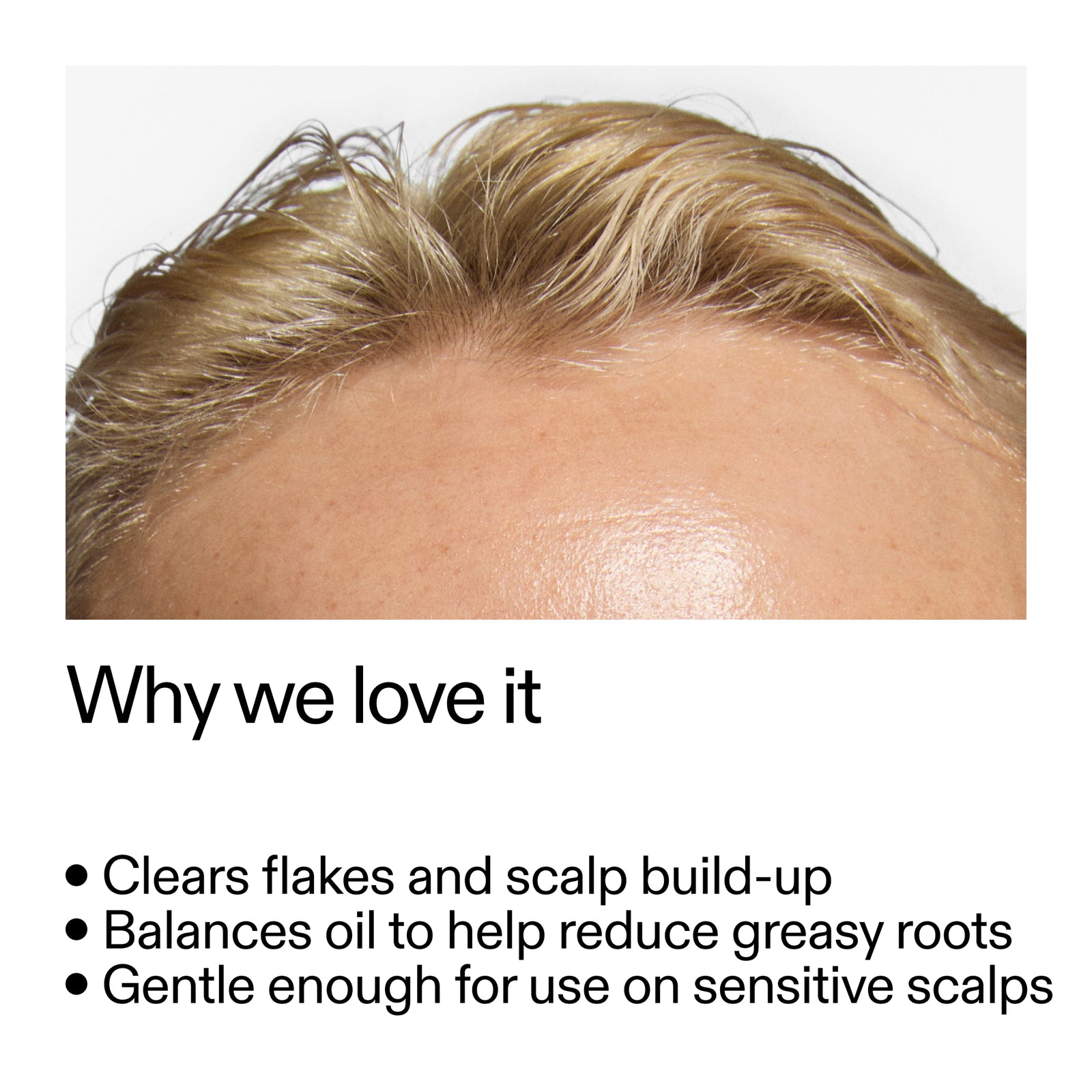 Close-up of a person's scalp with text highlighting Salicylic Acid Exfoliating Scalp Treatment  benefits