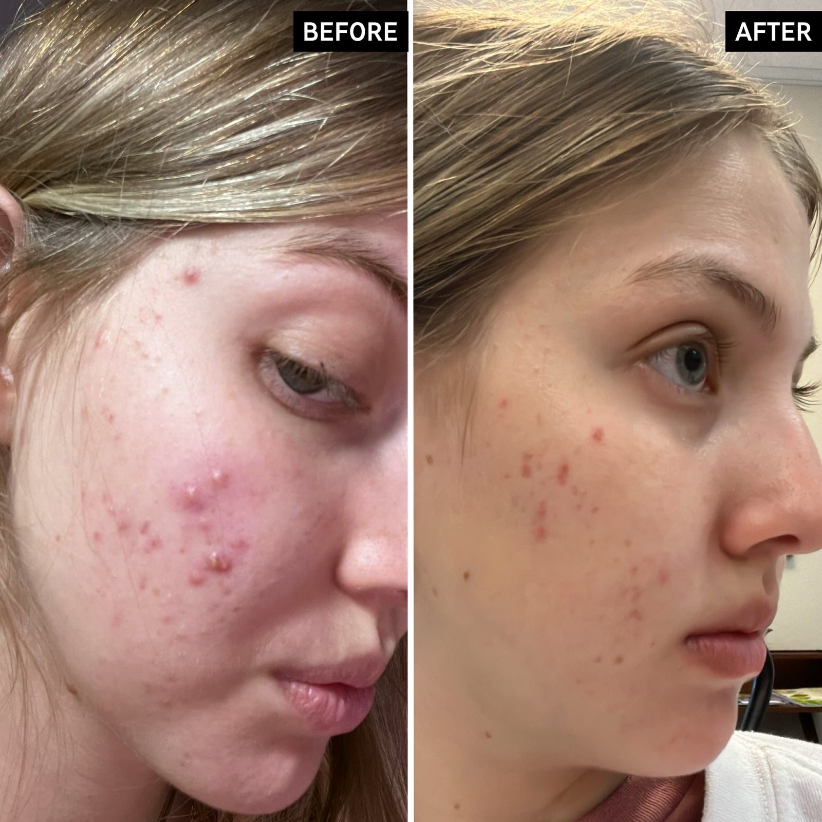 Before and After of Customer using Salicylic Acid Cleanser