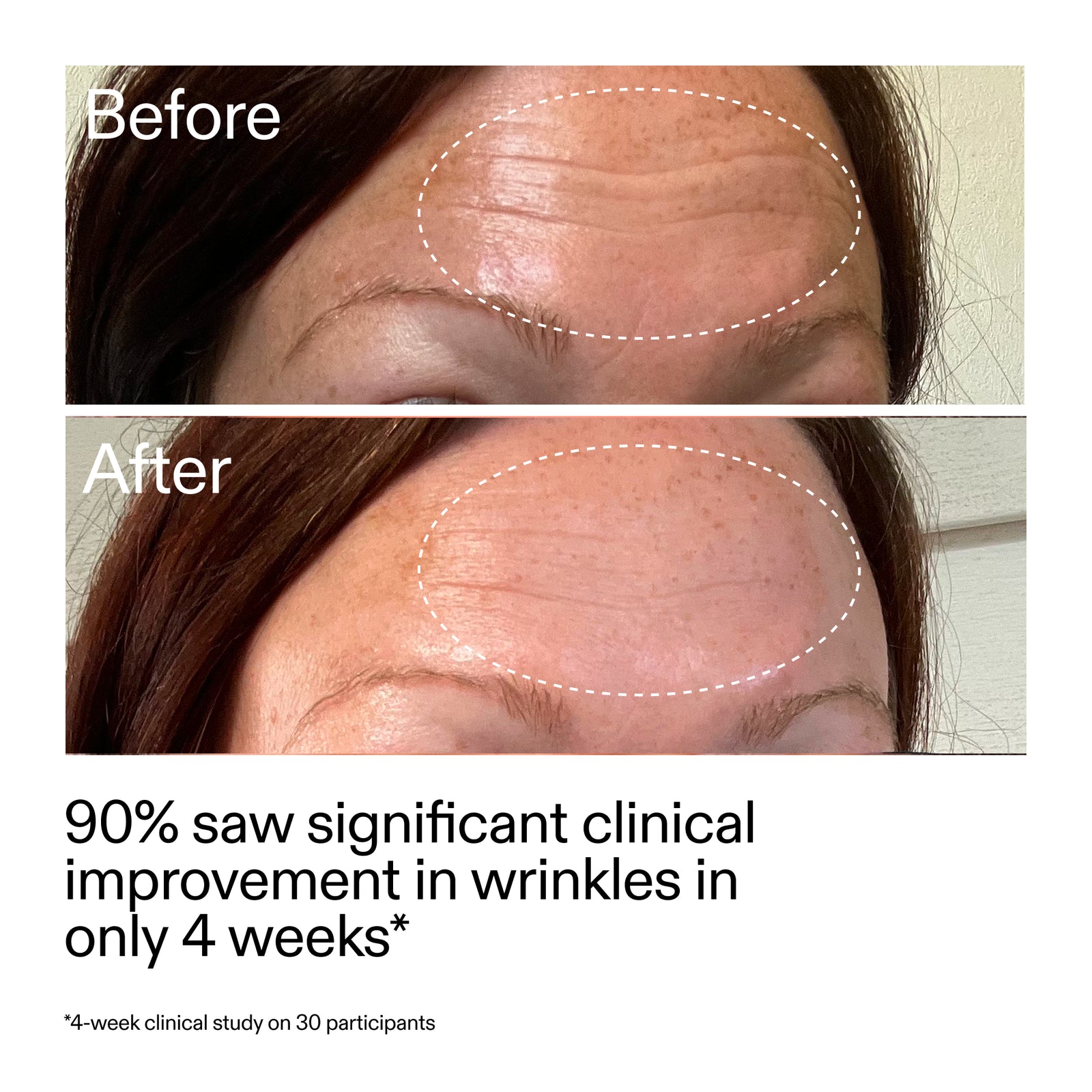 Before and after comparison of facial wrinkles with text indicating clinical improvement.