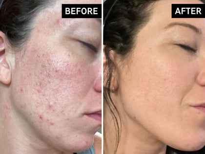 Before and after comparison of a person's face with acne on the left and clear skin on the right.