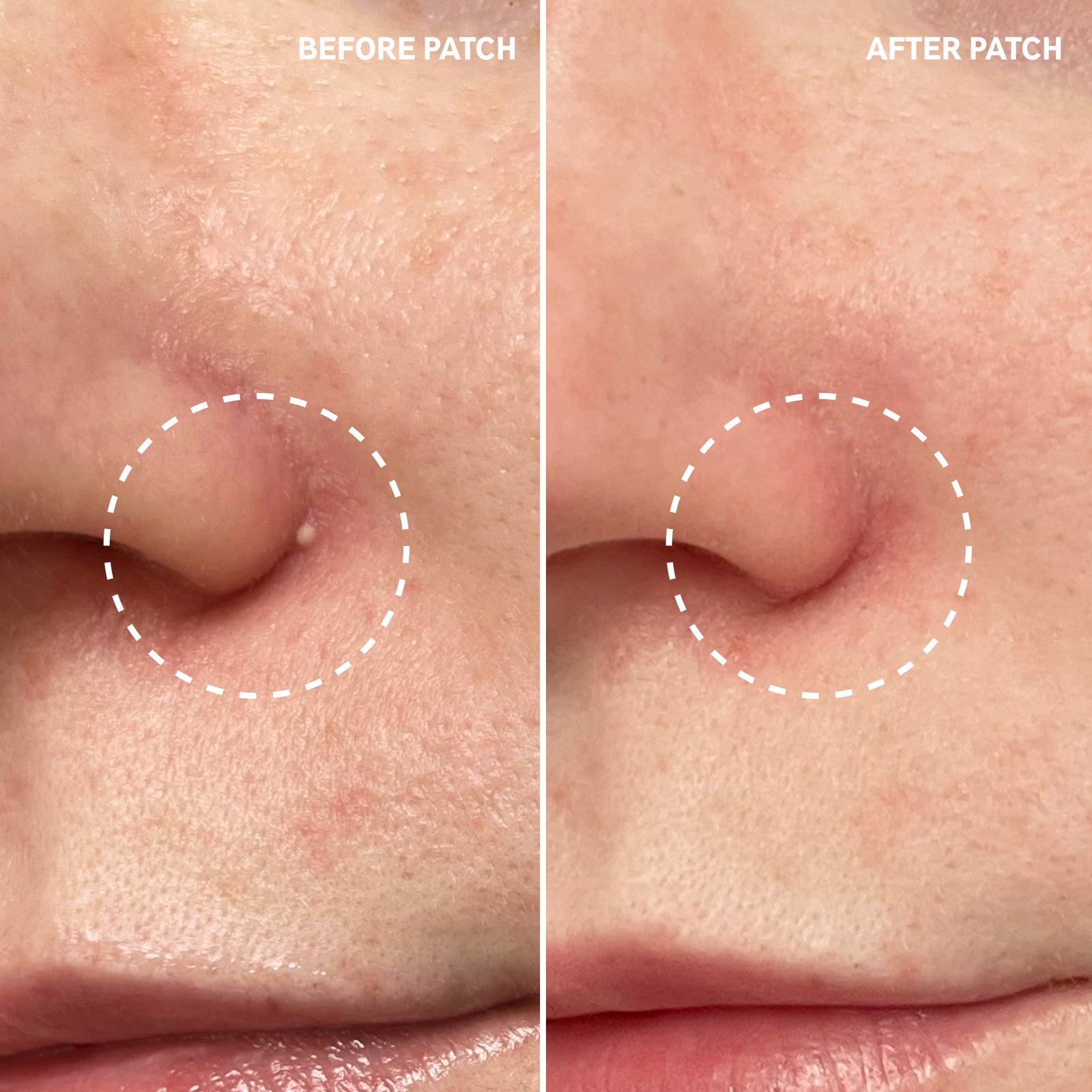 Before and after using Hydrocolloid Invisible Pimple Patches showing reduced blemish gunk