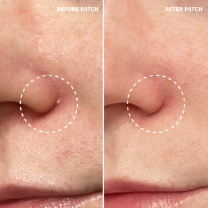 Before and after using Hydrocolloid Invisible Pimple Patches showing reduced blemish gunk