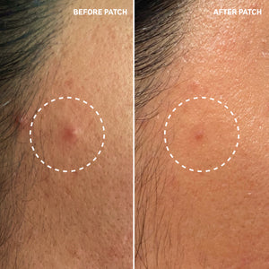 Before and after using Hydrocolloid Invisible Pimple Patches showing reduced blemish gunk