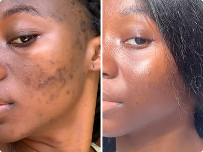 Before and after images of a customer to show how The INKEY List products cleared her blemishes.