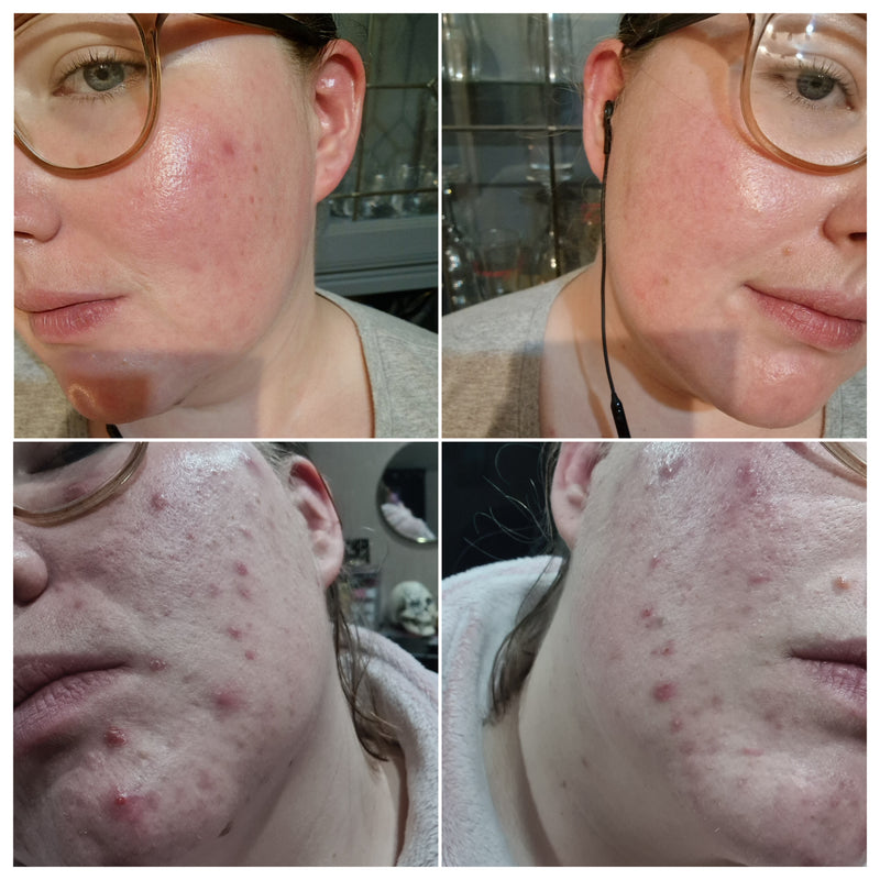 A four-panel before-and-after style collage showing close-up views of a person's face, focusing on the cheek and jawline, with visible red acne or facial bumps in the top panels and clearer skin in the bottom panels.