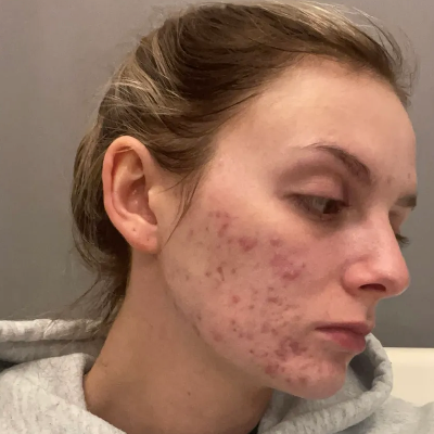 Close-up of a woman's face showing severe acne and blemishes on her cheek, wearing a light gray hoodie against a plain gray wall.