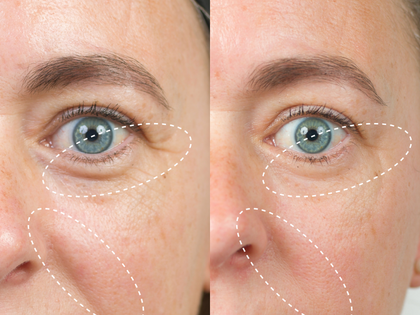 Side-by-side comparison of a woman's eye area with and without a treatment, showing before and after effects.