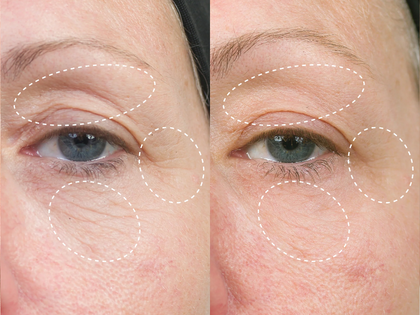 Before and after comparison of eye area with wrinkles highlighted on a person's face.
