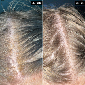 2 images of a scalp showing before and after using Salicylic Acid Exfoliating Scalp Treatment for 6 weeks