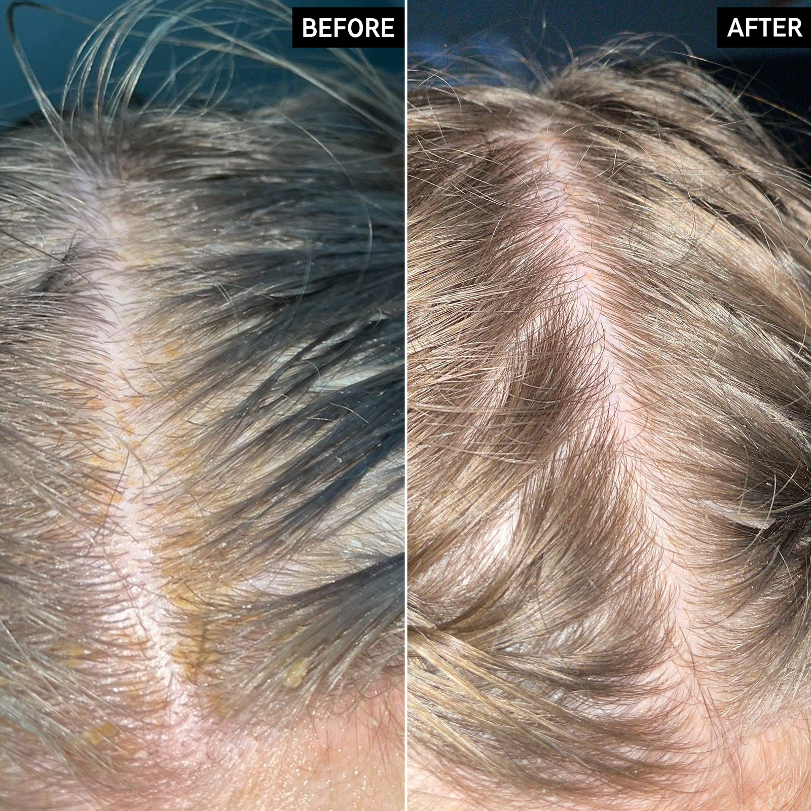 2 images of a scalp showing before and after using Salicylic Acid Exfoliating Scalp Treatment for 6 weeks