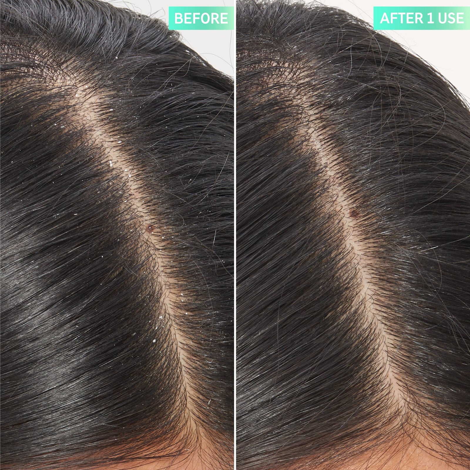 2 images of a scalp showing before and after using Salicylic Acid Exfoliating Scalp Treatment