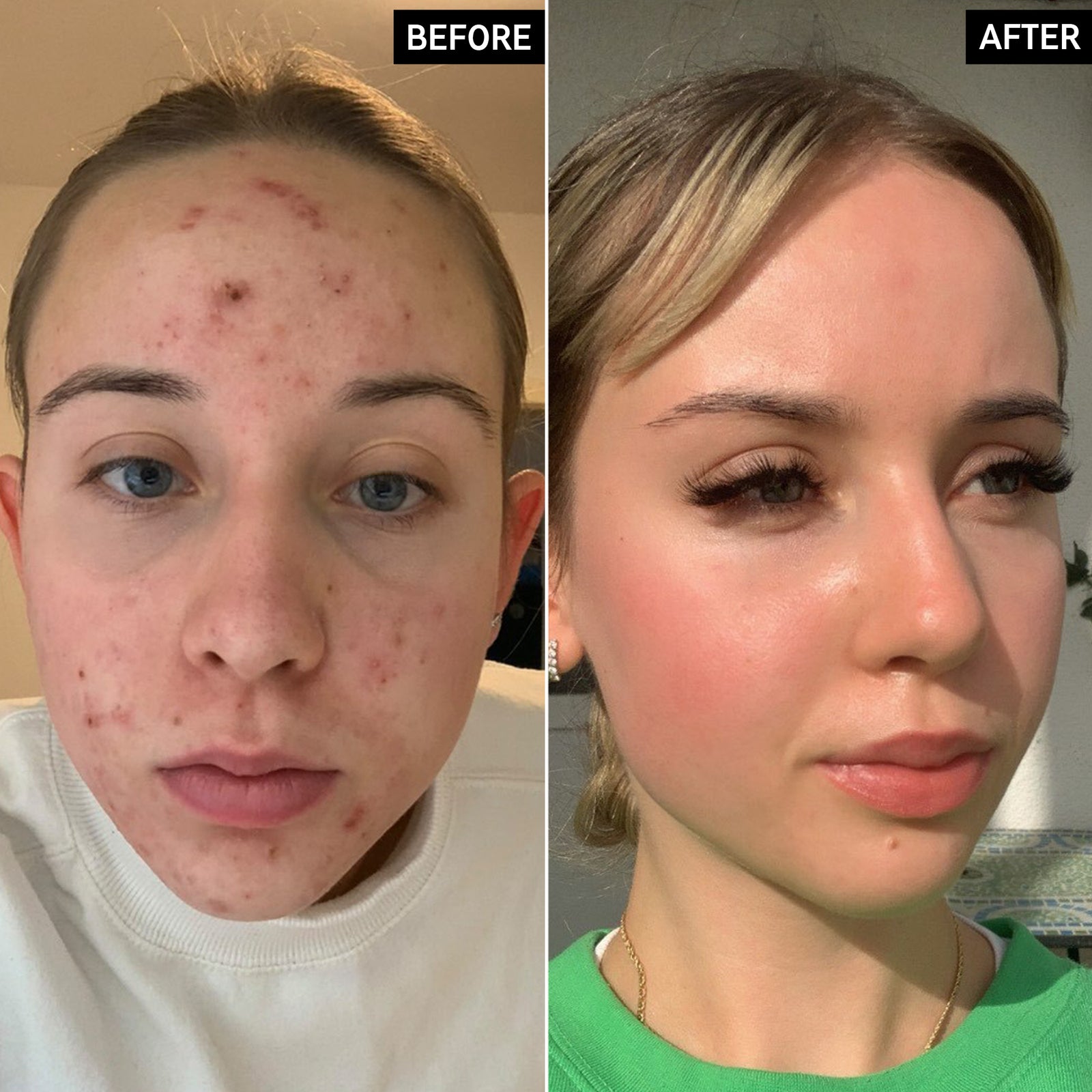 Hyperpigmentation Results Before & After With The INKEY List